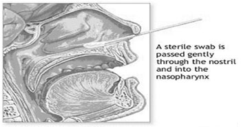 img/schnelltest/influenza_ab_complete/probenahme.jpg